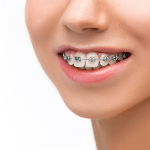 Invisalign Braces for Smile Makeover in Kelowna- Family Dental